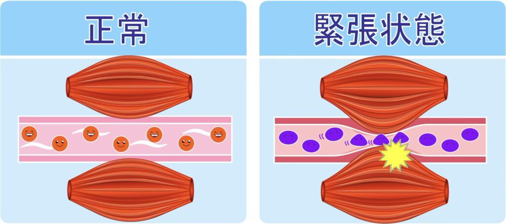 肩こりのメカニズム