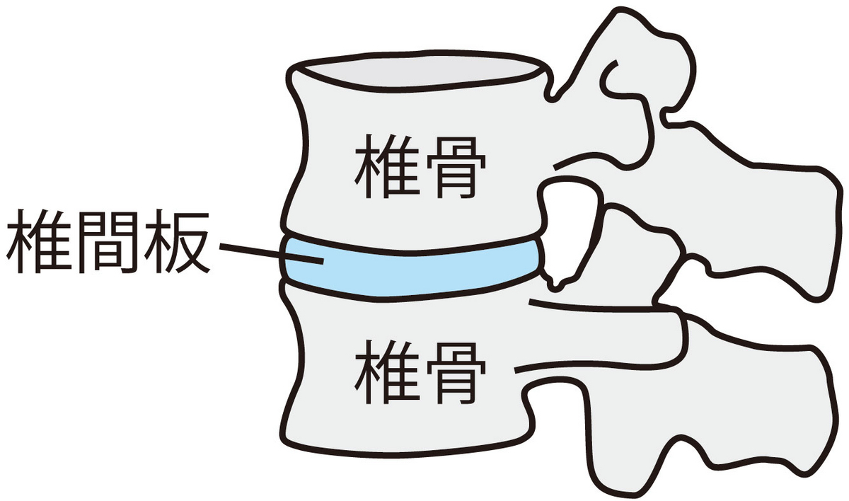 背骨の椎骨と椎骨の間にある椎間板の位置を示した図