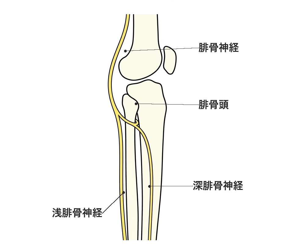 膝の外側で腓骨神経が腓骨頭を回り込み、深腓骨神経と浅腓骨神経に分かれる位置を示した解剖図