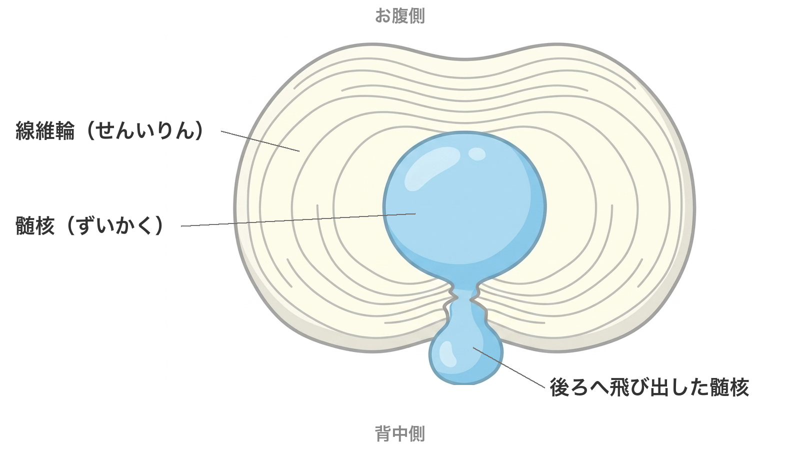 椎間板の断面図。線維輪と髄核、後ろへ飛び出した髄核
