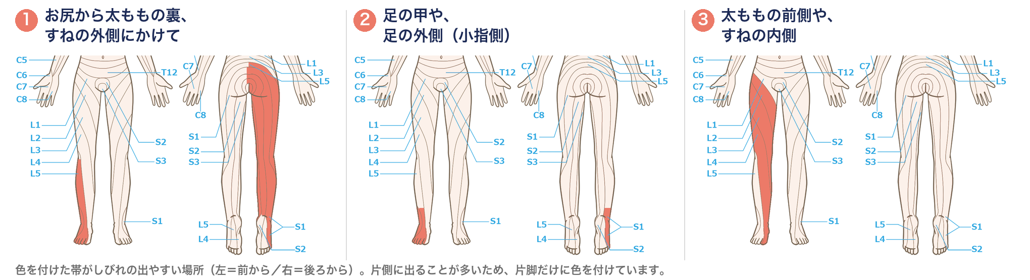 腰椎椎間板ヘルニアでしびれが出やすい場所。①お尻から太ももの裏・すねの外側、②足の甲・足の外側、③太ももの前側・すねの内側を、前面と後面の皮膚分節図で示した3枚並びの図