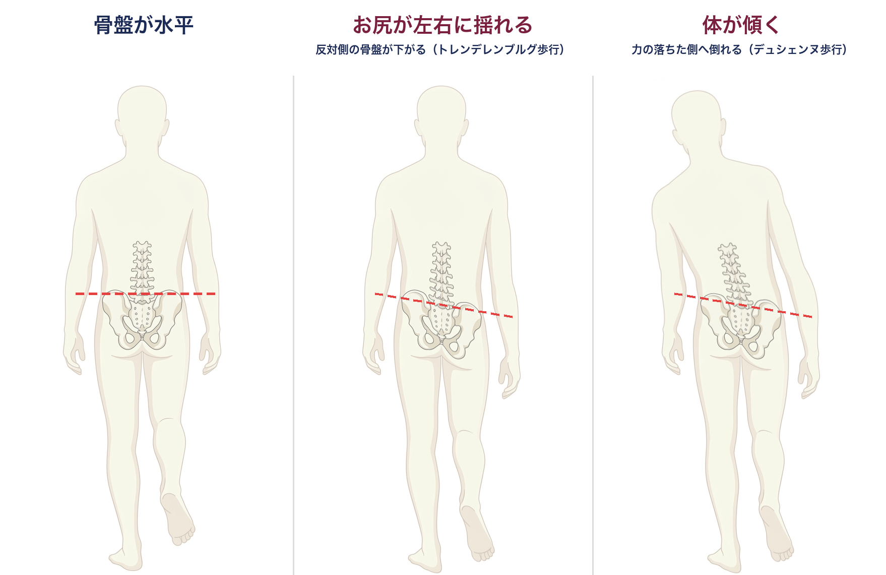 片足立ちで骨盤が水平な状態・反対側の骨盤が下がるトレンデレンブルグ歩行・体が傾くデュシェンヌ歩行の3コマ比較図